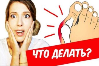 4 лучших средства для борьбы с болью при косточках на ногах