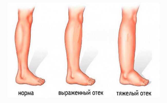 Распухшие и болезненные ноги